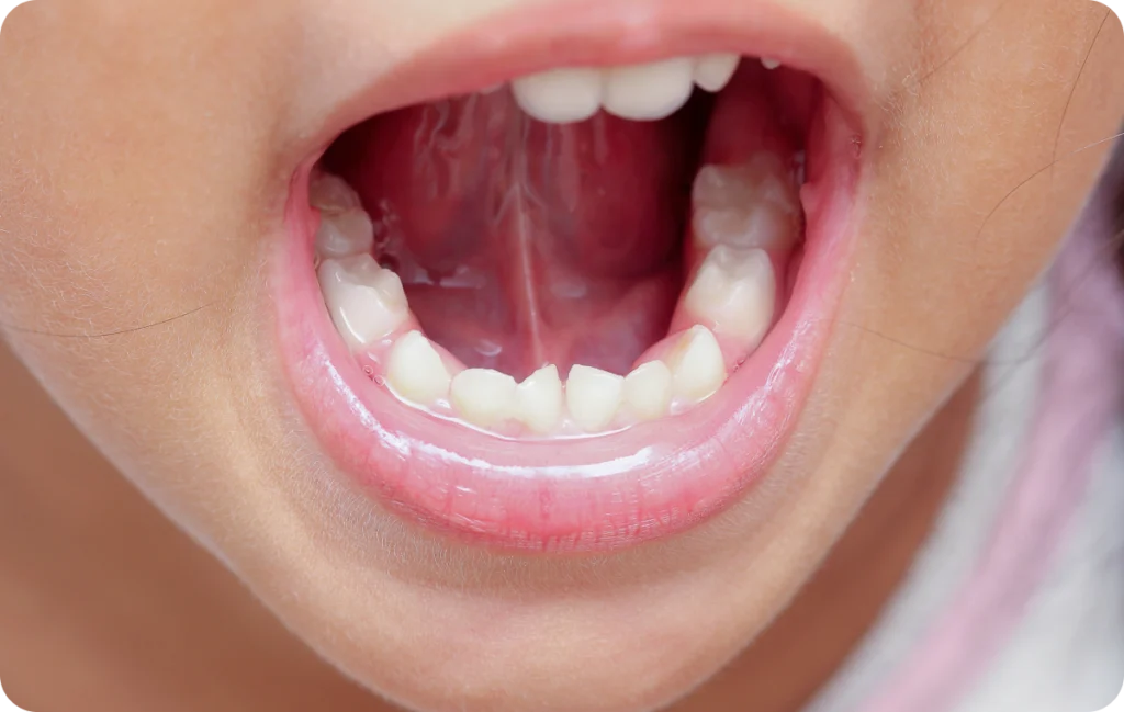 aligneurs invisibles eaubonne orthodontiste Dents qui se chevauchent : quelles solutions ? Ermont Eaubonne Orthodontie