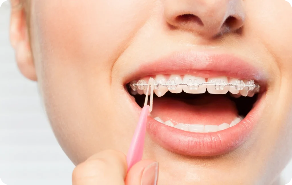 aligneurs invisibles saint prix dr papelard Appareils dentaires céramiques Ermont Eaubonne Orthodontie