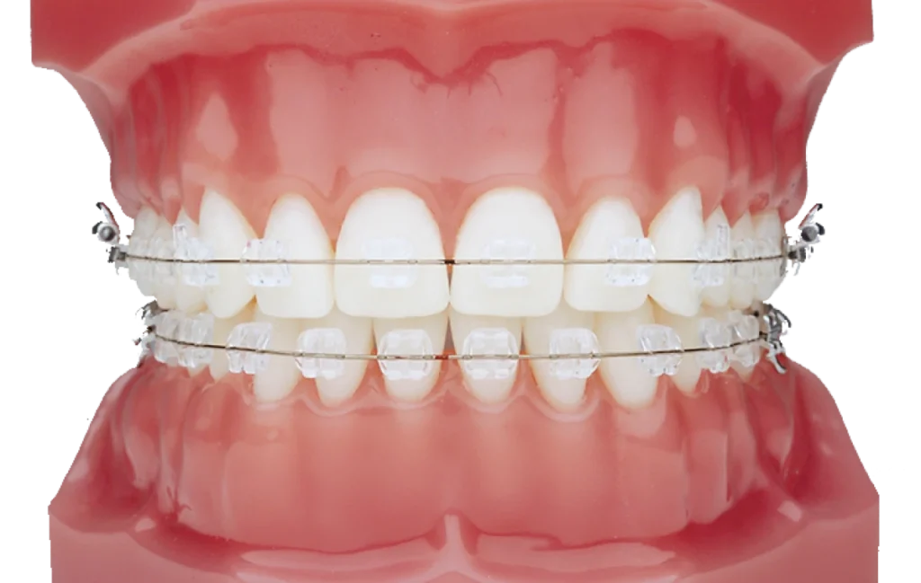 appareil dentaire saint prix dr foucart Appareil dentaire (céramique) Ermont Eaubonne Orthodontie