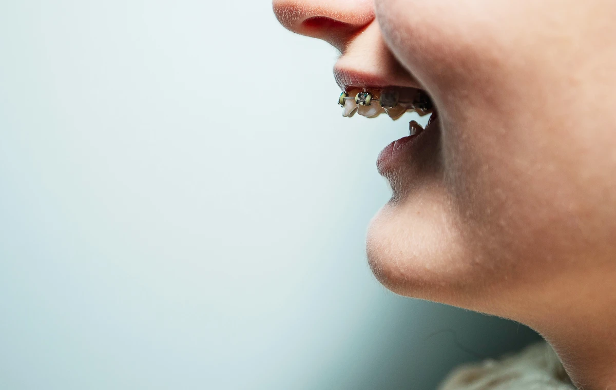 orthodontie andilly dr papelard specialiste Mâchoire décalée : que faire ? Ermont Eaubonne Orthodontie