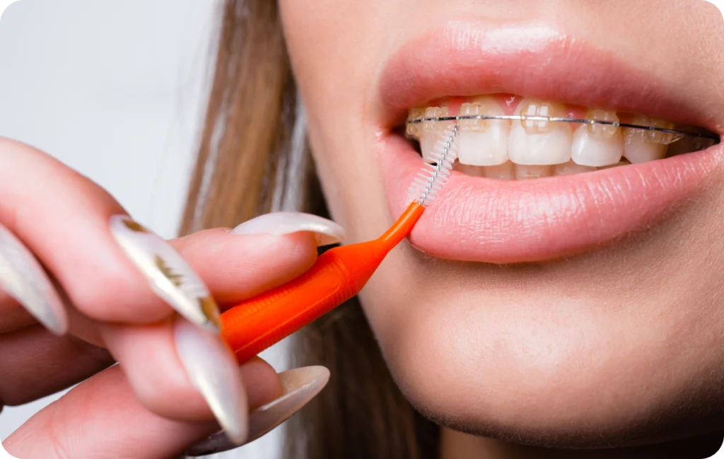 orthodontie interceptive eaubonne dr bouriau orthodontie interceptive eaubonne dr bouriau Hygiène dentaire avec appareil Ermont Eaubonne Orthodontie