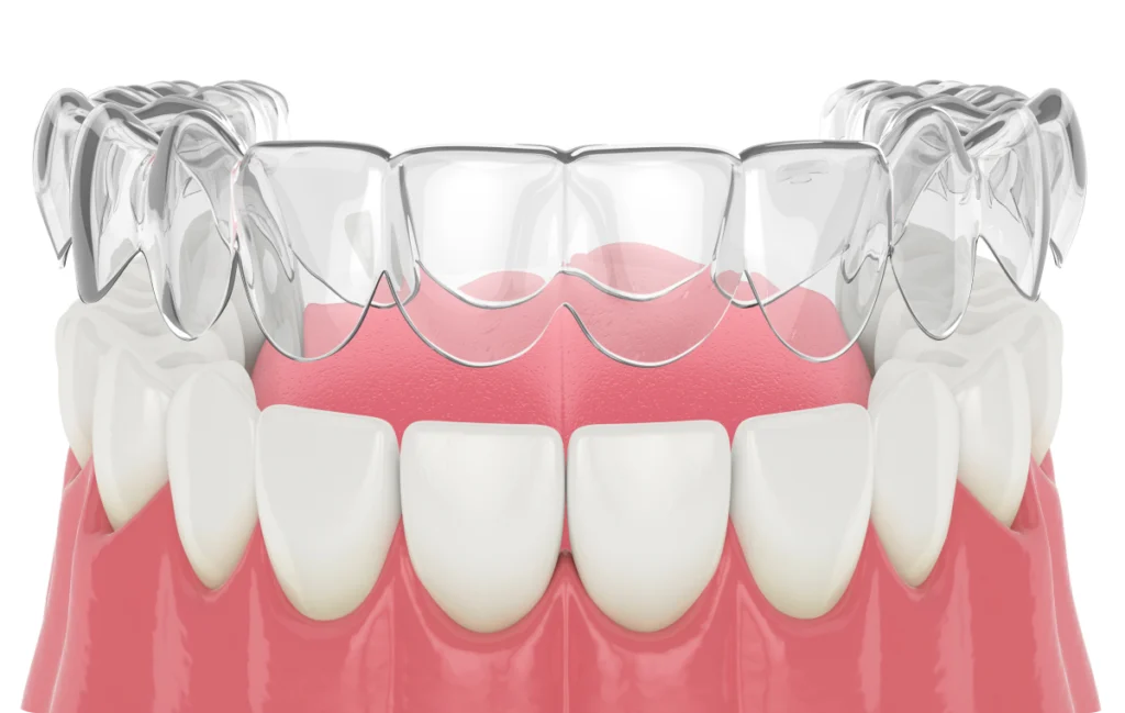 orthodontiste eaubonne dr foucart orthodontiste eaubonne dr foucart Fin de traitement et contention Ermont Eaubonne Orthodontie