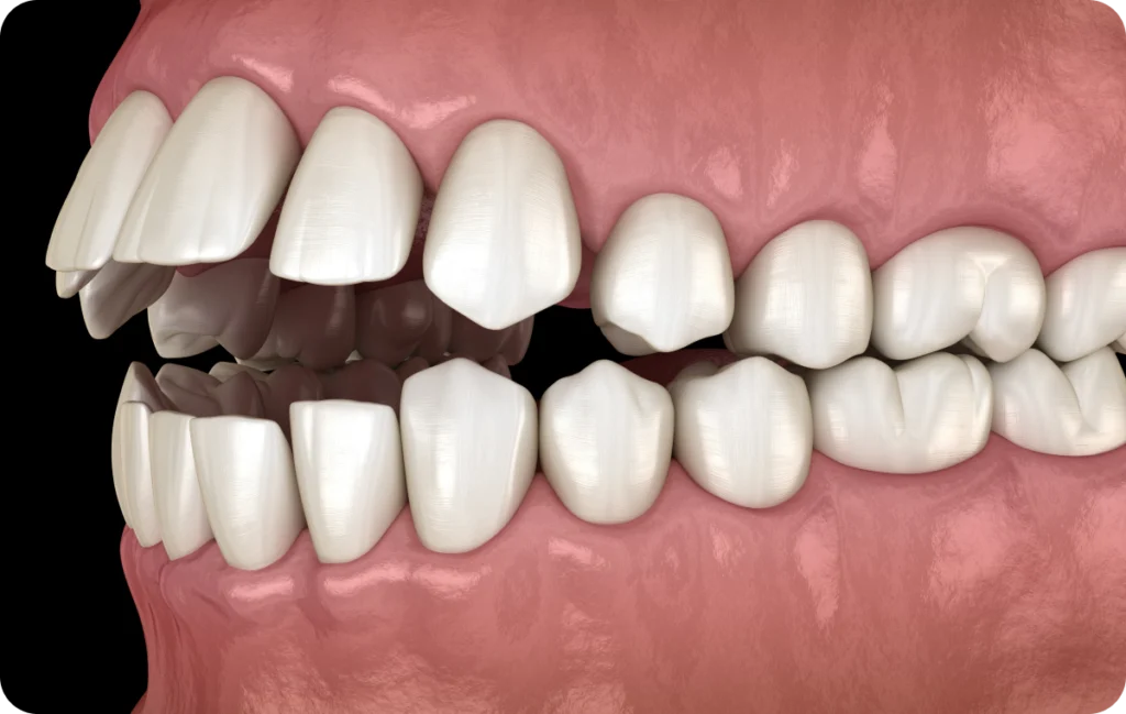 orthodontiste ermont eaubonne adultes orthodontiste ermont eaubonne adultes Mâchoire décalée : que faire ? Ermont Eaubonne Orthodontie