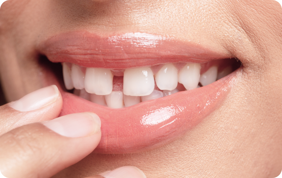 soin esthetique dentaire andilly Trou entre les dents : traitement possible ? Ermont Eaubonne Orthodontie