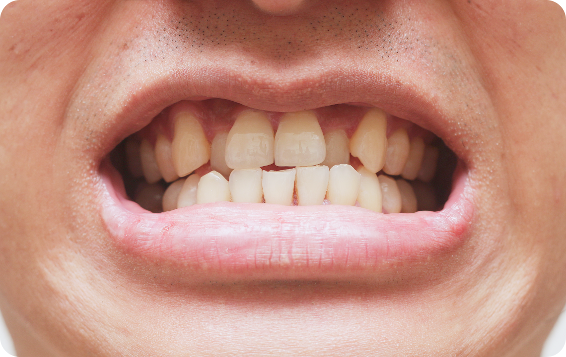 soin esthetique dentaire le plessis bouchard Dents qui se chevauchent : quelles solutions ? Ermont Eaubonne Orthodontie