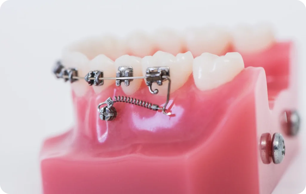 aligneurs invisibles soisy sous montmorency aligneurs invisibles soisy sous montmorency Traitements chirurgicaux Ermont Eaubonne Orthodontie