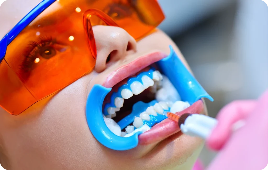 appareil dentaire ermont eaubonne Éclaircissement dentaire Ermont Eaubonne Orthodontie