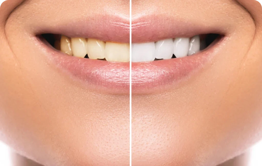 appareil dentaire sannois dr bourriau Éclaircissement dentaire Ermont Eaubonne Orthodontie