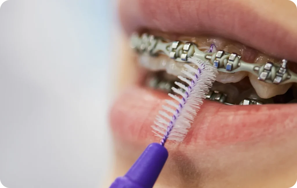 orthodontie interceptive andilly dr bourriau orthodontie interceptive andilly dr bourriau Orthodontiste Le Plessis-Bouchard Ermont Eaubonne Orthodontie